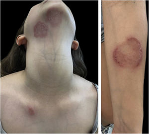 Erythematous-desquamative, circinated, vesico-crusted plaques with well-defined edges. They show centrifugal growth and central clearing.
