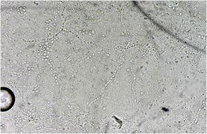 Direct mycological examination: skin desquamation containing septate, branched hyaline hyphae and arthroconidia. KOH 40% (×100).