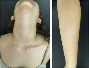 Complete resolution after 30 days of oral treatment.