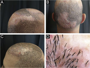 Clinical aspect (A, B, and C) and trichoscopy (D) - examination after the treatment.