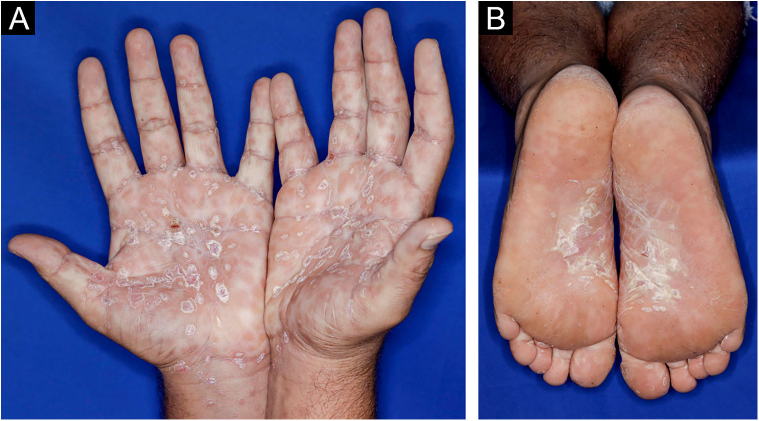 Secondary syphilis occurring under anti-CD20 therapy: risks ...