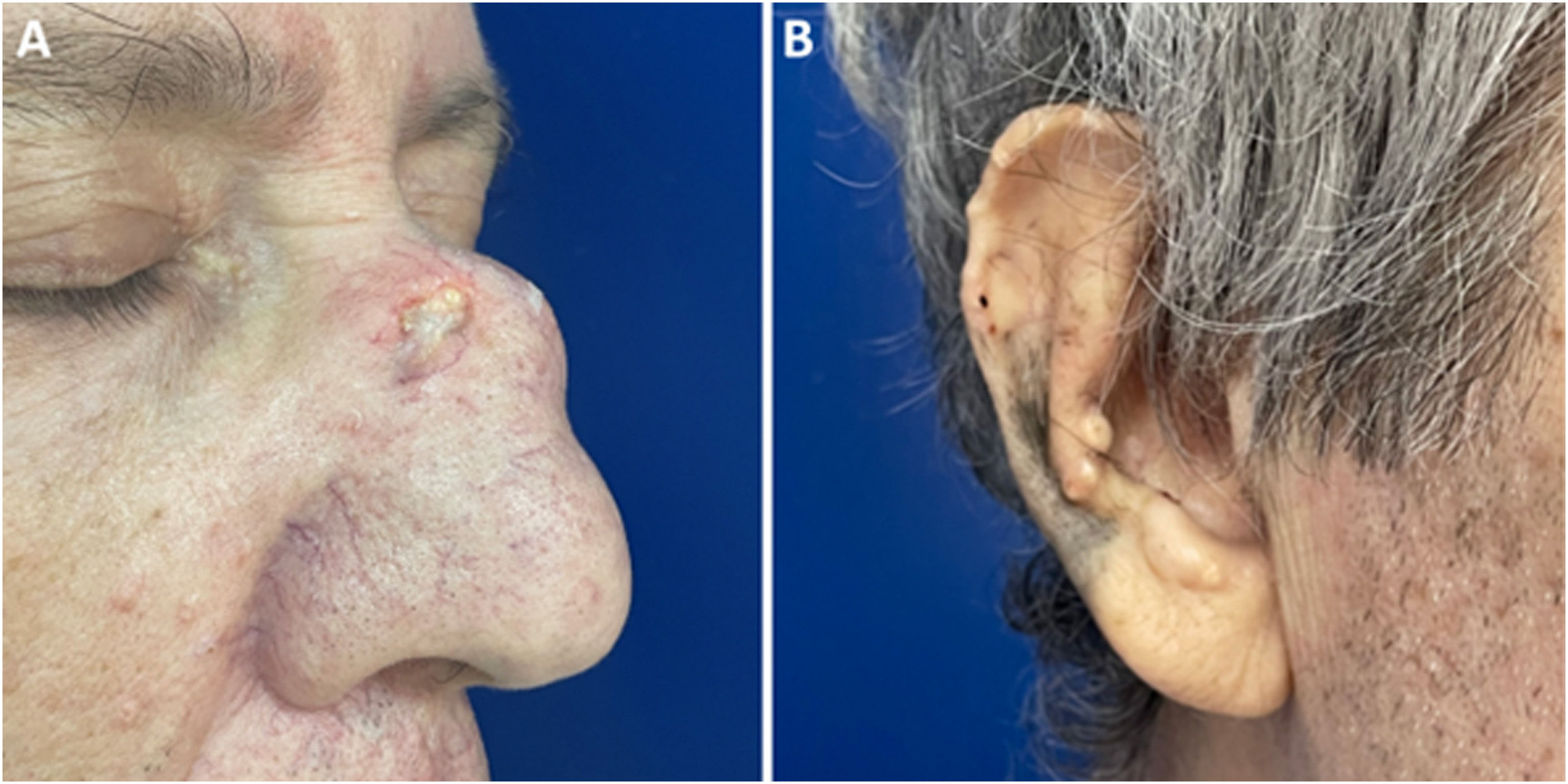 Dermoscopy Of Nasal And Auricular Gouty Tophi Anais Brasileiros De dermoscopy-of-nasal-and-auricular-gouty-tophi-anais-brasileiros-de