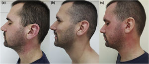 (A) Erythema and erythematous papules on the cheeks, auricles, and neck. (B) Face, auricles, and neck without skin lesions. (C) Erythema and erythematous papules on the scalp, face, auricles, and neck.