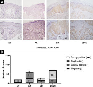Expression of SIRT6 in NT (Normal skin Tissue), AK (Actinic Keratosis), BD (Bowen Disease), and CSCC (Cutaneous Squamous Cell Carcinoma) tissues. (A) Representative images (magnified by ×100 × 200) of SIRT6 immunohistochemical staining in NT, AK, BD, and CSCC tissues using the SP method. (B) Bar graph illustrating the intensity of SIRT6 expression: n(NT) = 20-cases (0-cases of strong positive, 0-cases of positive, 13-cases of weak positive, and 7-cases of negative); n(AK) = 60-cases (3-cases of strong positive, 31-cases of positive, 22-cases of weak positive, and 4-cases of negative); n(BD) = 25 cases (9-cases of strong positive, 14-cases of positive, 2-cases of weak positive, and 0-cases of negative); n(CSCC) = 70-cases (46-cases of strong positive, 18-cases of positive, 6-cases of weak positive, and 0-cases of negative). Note: The full name of SP method is streptomycin peroxidase coupling method.