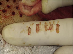 Harvested follicular units (FUs).
