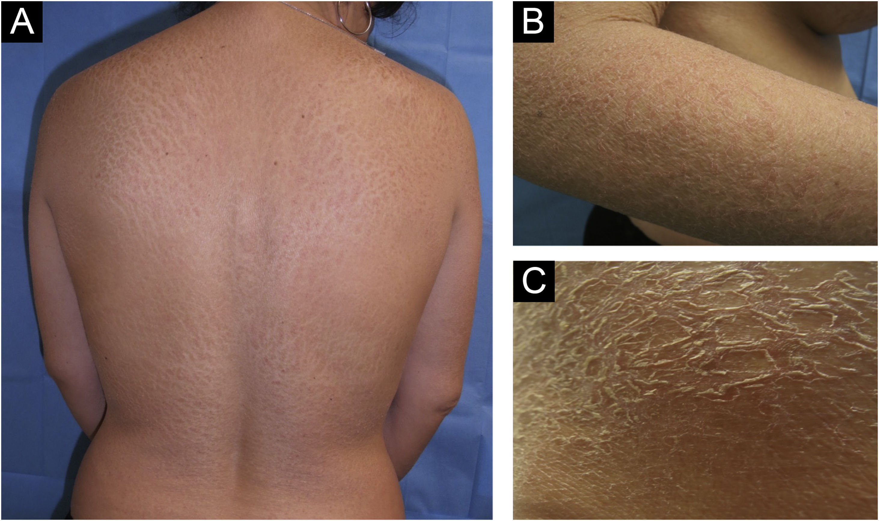 Paraneoplastic acquired ichthyosis as the first manifestation in breast ...