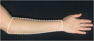 Representation of the area submitted to treatments ‒ dorsal side of the forearm (Source: Researchers archive).