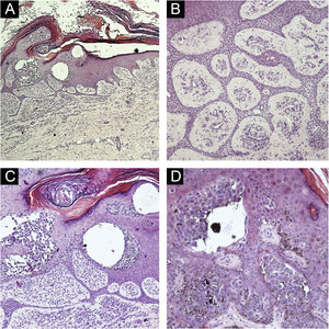 (A) Epidermis with hyperkeratosis, acanthosis, cords of anastomosed basaloid cells and intraepidermal clusters of atypical epithelial cells, (Hematoxylin & eosin, ×40). (B) Epidermis with basaloid cells forming thin anastomosing cords containing lumens and areas of atypia. Stroma with several vessels, (Hematoxylin & eosin, ×200). (C) Atypical basaloid cells within the epidermis, inferiorly forming anastomosing cords, hyperorthokeratosis, (Hematoxylin & eosin, ×200). (D) Atypical basaloid cells within the epidermis surrounded by pigmented dendritic melanocytes, (Hematoxylin & eosin, ×400).