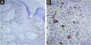 (A) Immunohistochemistry with Melan-A: Immunostaining in sparse dendritic melanocytes among atypical epithelial cells of the eccrine syringofibroadenocarcinoma ×100. (B) Immunohistochemistry with Melan-A: Immunostaining in sparse dendritic melanocytes among the atypical epithelial cells of the eccrine syringofibroadenocarcinoma ×400.