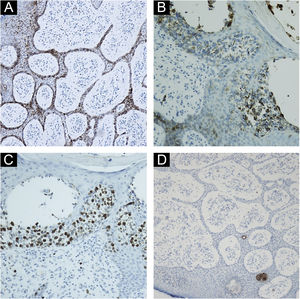 (A) Immunohistochemistry showing positivity with epithelial membrane antigen (EMA) ×200. (B and C) Immunohistochemistry showing that the epithelial cells stained with EMA (composition B) are the same ones that exhibit a high proliferative index by Ki-67 (composition C) ×400. (D) Immunohistochemistry showing positivity with CEA staining in eccrine ducts in the anastomosed epithelial cords ×100.