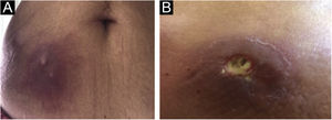 (A and B) Abscesses at PPD inoculation sites, one week after the procedure.