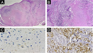 Histopathology of lesions of “PPD-itis”. (A) (Hematoxylin & eosin, ×40). Showing granulomatous reaction with extensive caseous necrosis. (B) (Hematoxylin & eosin, ×100). Detail of the tuberculoid granuloma with caseous necrosis. (C and D) Negative immunohistochemistry for Mycobacterium tuberculosis.