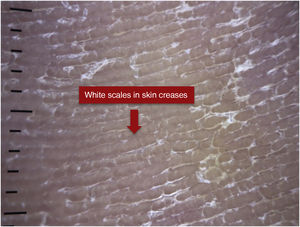 Dermoscopy of a patient with tinea pedis.