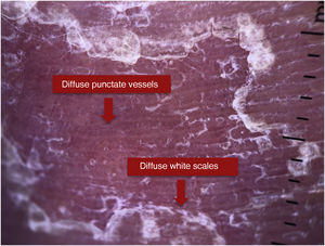 Dermoscopy of a patient with psoriasis.