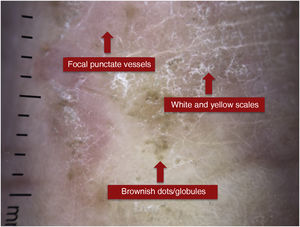 Dermoscopy of a patient with palmar eczema.