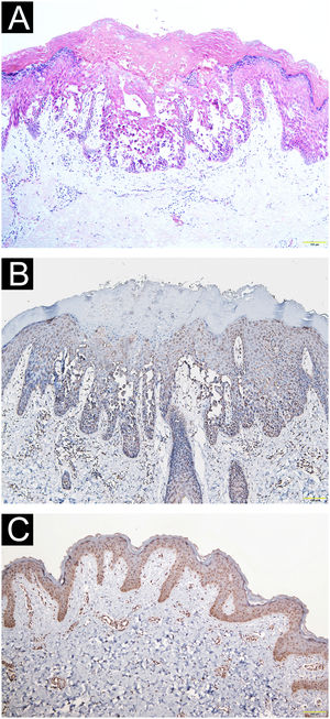 Pathological and immunohistochemical observation. (A) Epidermal hyperkeratosis, focal parakeratosis and dyskeratosis without koilocytosis, suprabasal acantholysis with “dilapidated brick-wall” appearance, and mild perivascular lymphohistiocytic infiltrate in the upper dermis (Hematoxylin & eosin, ×100). (B‒C) Immunohistochemical staining revealing reduced epidermal hSPCA1 expression in the Hailey-Hailey disease lesion (B) compared with normal control skin (C) (×100).
