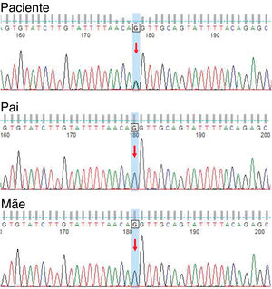 Genetic detection. Sanger sequencing of peripheral blood revealing a novel heterozygous splicing mutation c.1840-1G>A in intron 19 of ATP2C1 in the patient, and a wild-type sequence in his parents.