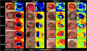 Clinical (left panels) and LSCI (right panels) images of full-thickness skin grafts on the scalp of the four patients. LSCI images show differences in perfusion in a semiquantitative scale, from black (meaning no perfusion), to red (intense perfusion). Patient 1 had a bluish-to-black recipient bed on day 0, and the graft remained poorly perfused until day 28, culminating in subtotal graft necrosis. Patient 2 had a bluish graft bed (meaning low perfusion) but gradually recovered over four weeks, and the graft necrosis area was less than 50%. Patients 3 and 4 had better-perfused graft beds and showed intense perfusion after day 14 onwards. By day 28, necrosis extensions were 16% and 9%, respectively. LSCI, laser speckle contrast Imaging; APU, arbitrary perfusion units.