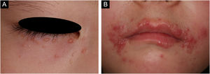 Numerous small erythematous papules were located on the lower eyelid (A) and around the mouth (B).