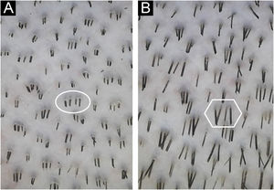 The same hair shafts’ length analyzed before (A) and after (B) 36 hours to obtain hair growth speed. * Ten individual shafts were measured in each picture, for each intervention.
