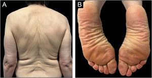 After four weeks of treatment with ustekimumab, there was a great improvement of the lesions (A‒B).