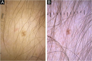 (A) Trichoscopy image low hair density with a predominance of thin hairs before treatment with LDOM. (B) Trichoscopy image of the same area, showing a significant improvement in hair density and predominance of thicker hair shafts after one year of LDOM treatment.