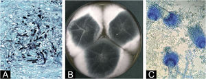 Supplementary tests: (A) Skin biopsy, (Groccot, 40×). Septate hyphae, with right angulation, vesiculation and pseudohyphae. (B) Microbiological culture of skin biopsy on dextrose agar. Colonies composed of a bluish-green central portion surrounded by a whitish foamy edge. (C) Lactophenol blue stained microscopy of microbiological culture. Septate hyaline hyphae were found with typical reproduction forms of Aspergillus fumigatus: aspergilate heads, with smooth and regular conidiophores, club-shaped vesicles covered in their upper third by uniseriad phialides that gave rise to smooth and globose conidia.