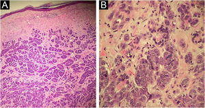 (A) Neoplasm consisting of basophilic cells, forming well-developed nests and masses that infiltrate the dermis, without affecting the epidermis (Hematoxylin & eosin, ×40 and ×100); (B) Cells with eosinophilic cytoplasm and pleomorphic nuclei, vesicular chromatin (red arrow), evident nucleoli (blue arrows) and frequent atypical mitoses (black arrows); (Hematoxylin & eosin, ×40 and ×100).