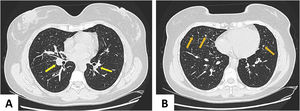 Computed tomography of the chest showing parabronchial nodules – yellow arrows (A) and multiple peripheral centrilobular micronodules – orange arrows (B).