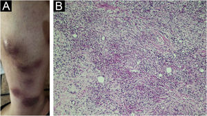 (A) Multiple erythematous nodules on the right leg at the onset of the presentation. (B) Neutrophil-rich infiltrate forming small abscesses in the dermis and subcutaneous tissue (Hematoxylin & eosin, ×200).