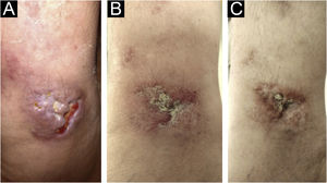 Therapeutic response. (A) Lesion on the right internal malleolus with infiltration, ulceration and necrosis. (B) After 60 days of treatment, showing significant reduction in infiltration and ulceration. (C) Complete resolution after 120 days.
