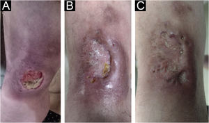 Therapeutic response. (A) Lesion on the left external malleolus with ulceration and infiltrated edges. (B) After 60 days of treatment, the ulceration resolved, but part of the infiltrated edge persisting. (C) Complete resolution after 120 days.