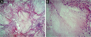 Photomicrographs of the histopathology of the nasal dorsum lesion. Eosinophilic, amorphous or crystalloid deposits in the dermis, surrounded by a granulomatous inflammatory infiltrate. Hematoxylin & eosin, ×100 (A) and ×400 (B).