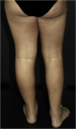 Stiff skin syndrome. An 11-years-old female patient, with sclerotic plaques showing a cobblestone pattern on the right gluteal and thigh region, also with a difference in length between the limbs.