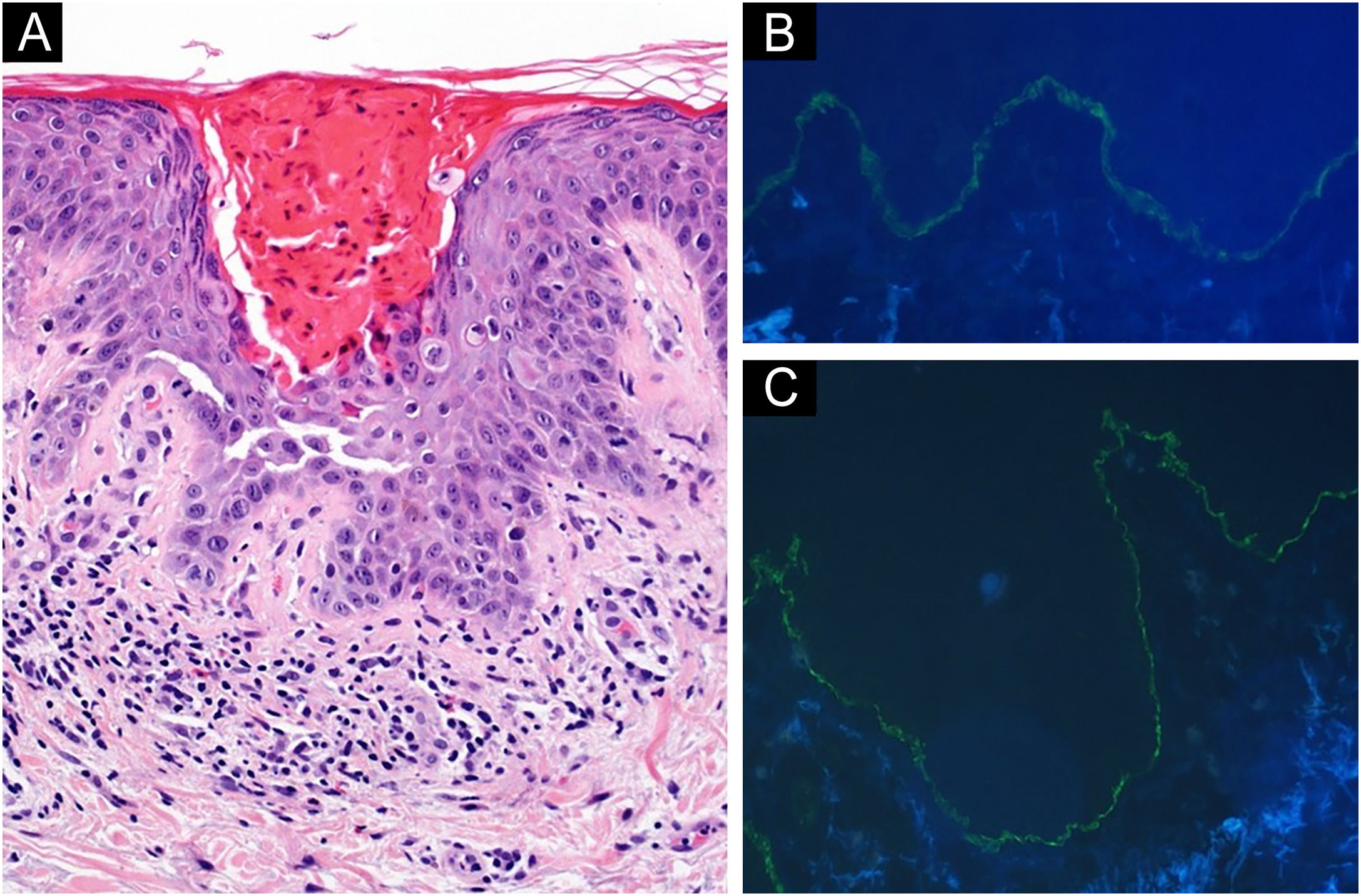 association-of-bullous-pemphigoid-and-grover-disease-induced-by-immune