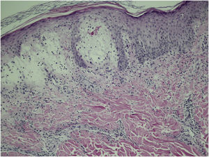 On histopathology there is marked edema of the superficial dermis associated with a lymphocytic and neutrophilic infiltrate and extravasation of red blood cells. Absence of spongiosis, vasculitis or vacuolar damage (Hematoxylin & eosin, ×100).