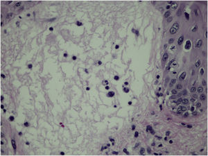 Detail of the edema of the papillary dermis, corresponding to the clinical pseudo-vesicle (Hematoxylin & eosin, ×400).