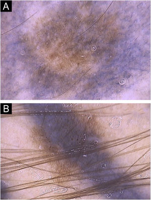 (A) Tattooing pigment causing partial obliteration of the nevus and (B) total obliteration of the nevus, in which the melanocytic network cannot be clearly observed in the tattooed area.
