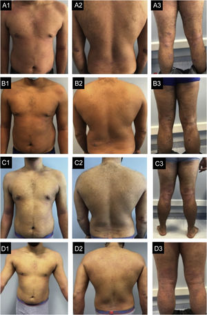 Case 3. (A1‒A3) basal state: Severe eczema, widespread, with areas of extensive moderate erythema and edema in the trunk and areas of nummular configuration with intense oozing and crusting and excoriation in the elbows, buttocks, thighs, and legs. (B1‒B3) After 6-months of dupilumab: Very small improvement. (C1‒C3) After 6-months of Baricitinib: No improvement with new lesions in the feet. (D1‒D3) After 4-months of tralokinumab: Global improvement, more evident in the trunk, with almost clear skin. In the limbs, edema and lichenification are less severe and there are no excoriations, which reflects an important improvement in pruritus.
