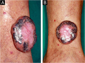 (A‒B) Lateral and frontal view of the exophytic pedunculated tumor, 40-mm in its largest diameter, showing an erythematous, shiny, pearly surface, and pigmented areas on the periphery.