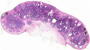 On histopathology, a panoramic view showed a polypoid tumor consisting of basaloid neoplastic aggregations of varyng sizes and shapes with peripheral palisading, limited to the upper and middle part of the polyp.