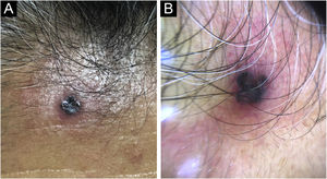 Physical examination. (A) A dark brown-black colored papule. (B) Dermoscopy. Blue-gray ovoid nests and ulceration, surrounded by a 3 mm erythematous and elevated rim.