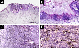 Histopathology findings (A) Well circumscribed tumor arranged in lobes (Hematoxylin & eosin, 4×). (B) Basaloid and ghost cells with compact keratinization (Hematoxylin & eosin, 10×). (C) Basaloid cells and numerous dendritic melanocytes (Hematoxylin & eosin, 20×). (D) Dendritic pigmented melanocytes (Hematoxylin & eosin, 40×).