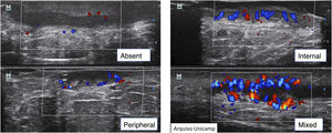 Type of vascularization on Doppler.