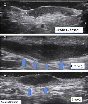 Grading of fibrosis.