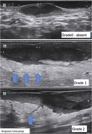 Grading of perilesional edema.