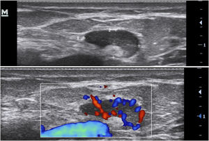 Reactive lymph node, without important changes.
