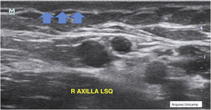Changes in the thickness and echogenicity of the dermis.