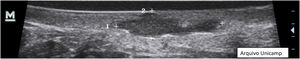 Fluid collections.