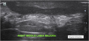 Fistulae.